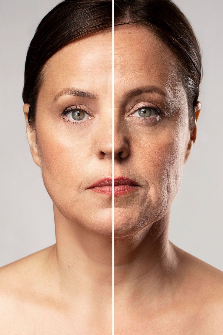 Aplicação de Botox / Toxina Botulínica